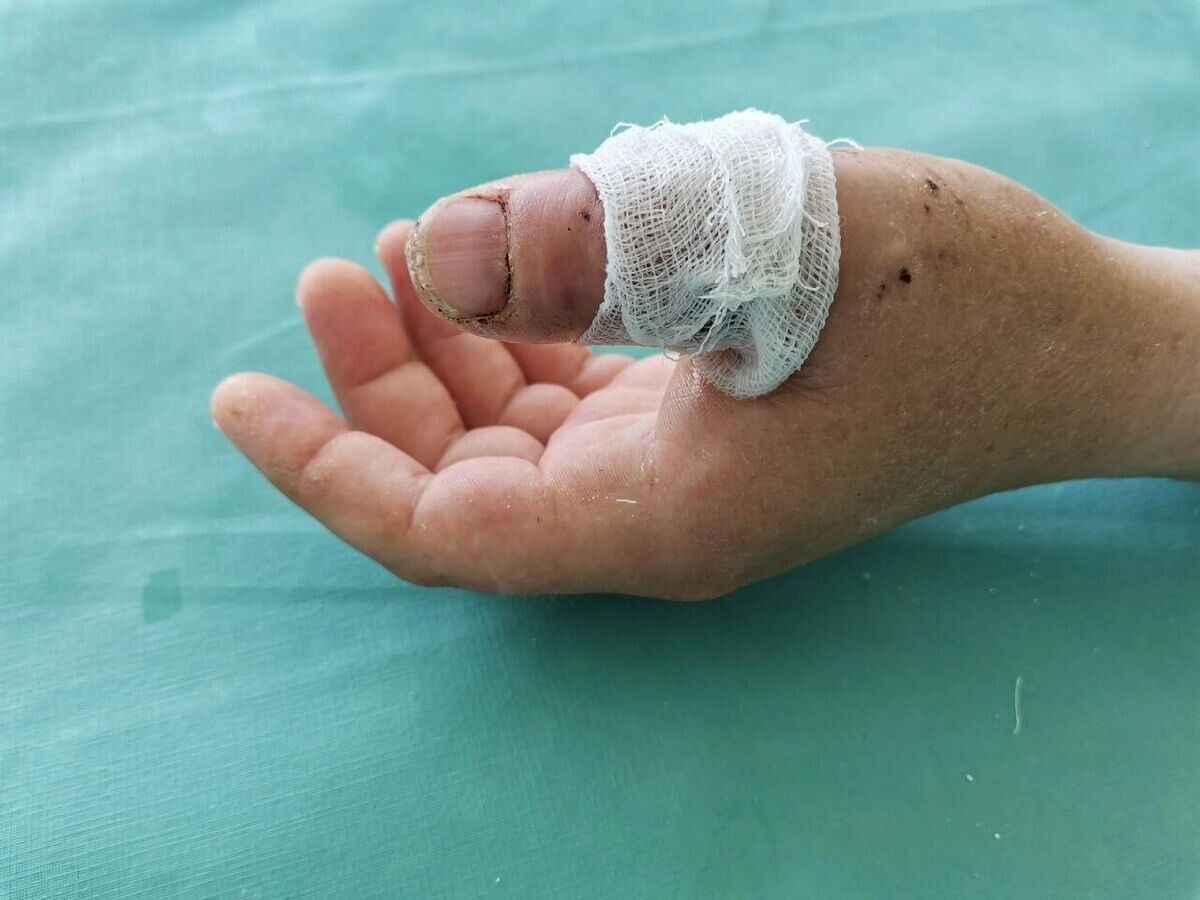    Врачи клинической больницы имени Г.А. Захарьина в Пензе восстановили мужчине палец, который отрезало "болгаркой"© Фото : Министерство здравоохранения Пензенской области/ВКонтакте