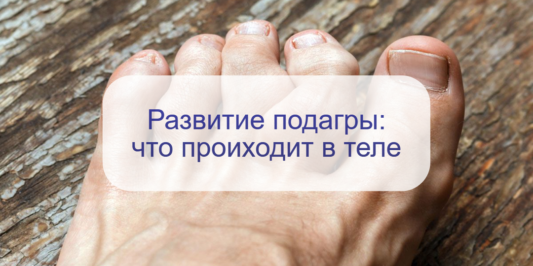 Почему подагра опасна? Врач рассказала – какие органы от нее страдают и что делать