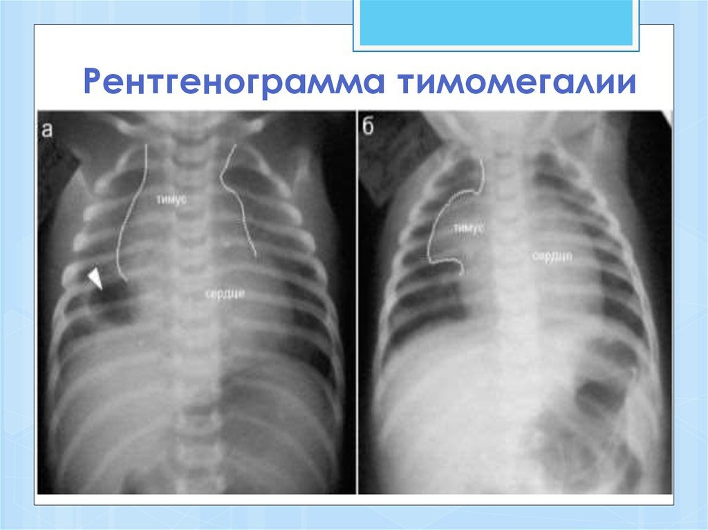 УЗИ вилочковой железы у детей