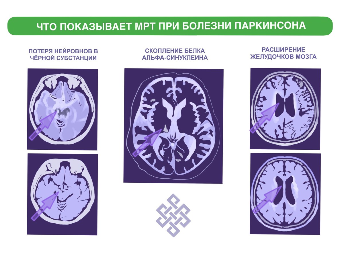 Что показывает МРТ при болезни Паркинсона 