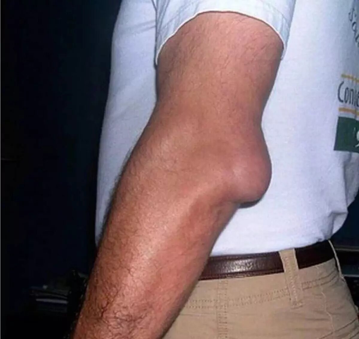 Бурсит локтевого сустава. Фото: соцсети