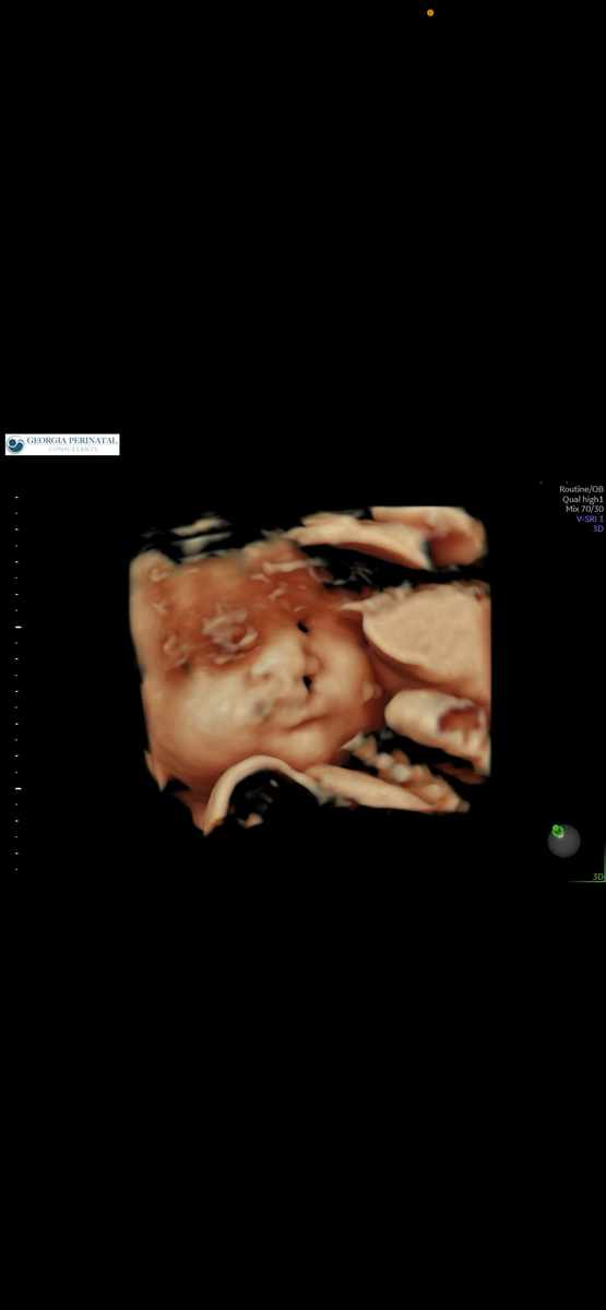 3д узи моего малыша 