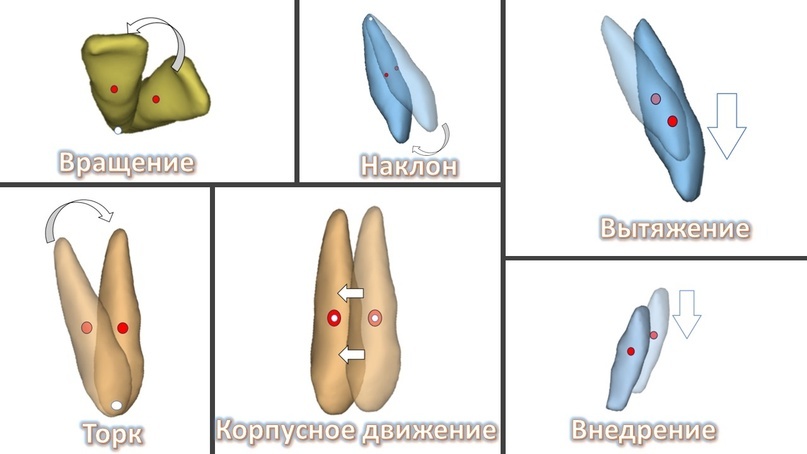 Типы перемещения зубов