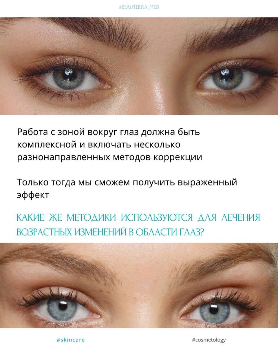 Работа с зоной вокруг глаз - разбираем методы устранения мимических морщин, признаков усталости и тёмных кругов, комментарии косметологов клиники БЬЮТЕРРА
