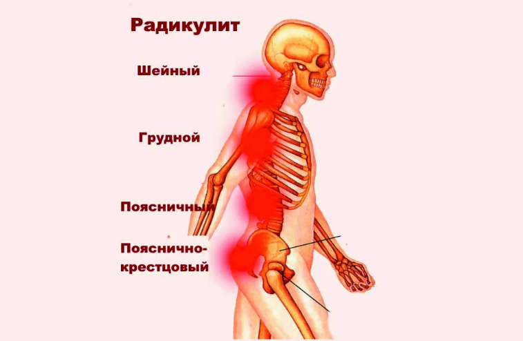 Радикулит приносит человеку выраженный дискомфорт и боли, может быть мучительным для пациента и, поэтому, его лечение должно быть быстрым, эффективным и комплексным.-2