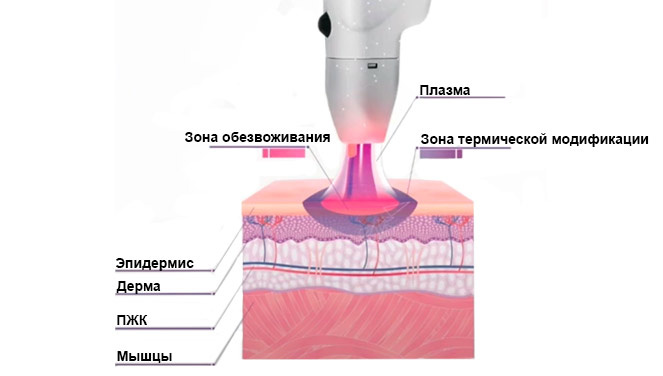 
Схема воздействия холодной плазмы на ткани