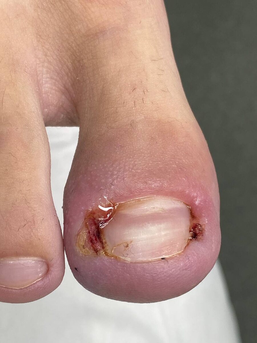 В данном случае к нам обратился молодой человек, врастание ногтя началось на фоне гипергидроза.