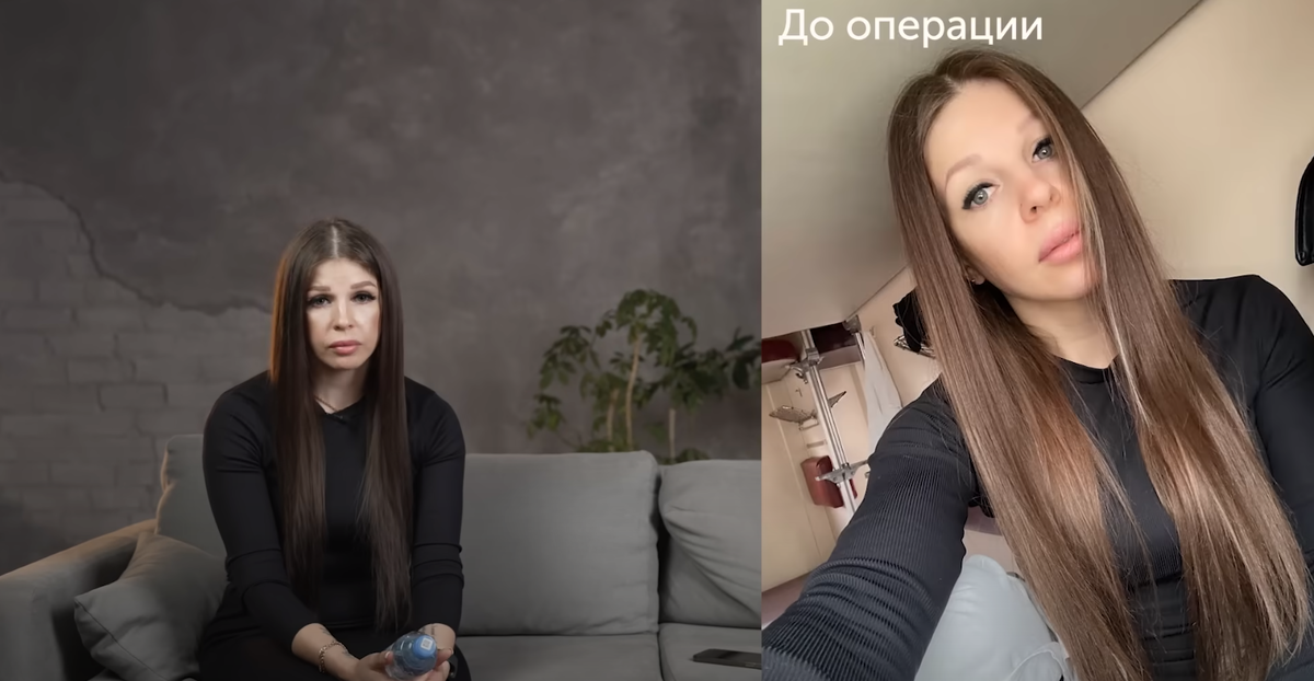 Случайно наткнулась на страшное видео Екатерины Коваленко в U-tube с описанием того, как некий Салим Рагимов в клинике "Мерджан" (Баку) изуродовал ей лицо. Видео ужасное.
