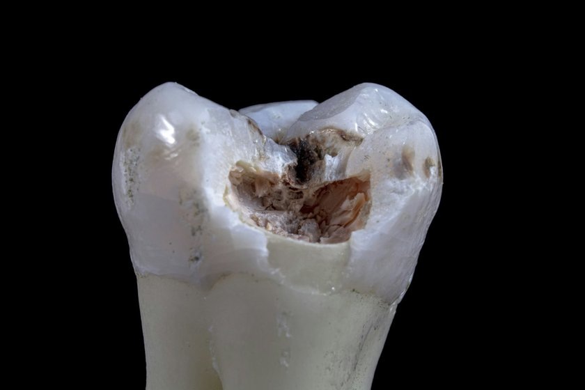 Согласно статистике, кариес поражает зубы около 3,5 млрд людей — немногим меньше половины населения планеты.