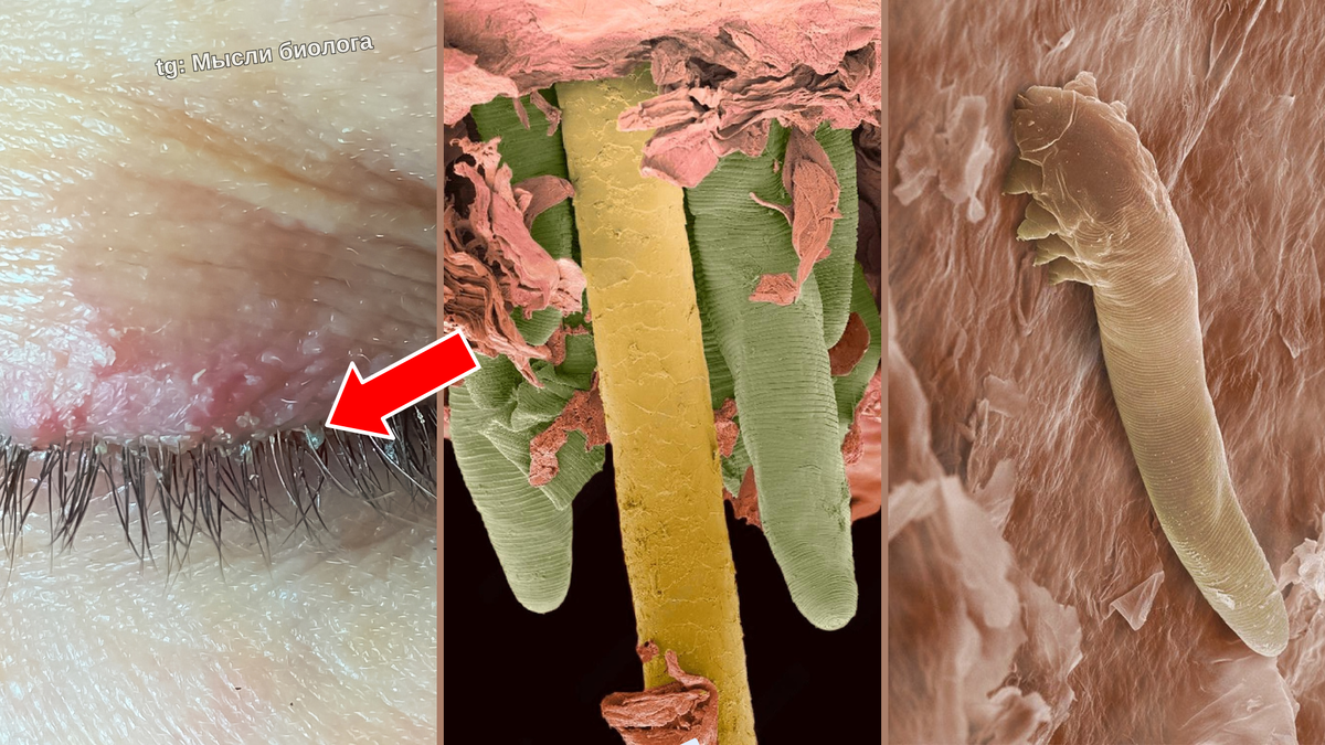 Ресничные клещи внутри волосяного фолликула. Макрофотография и изображения с электронного микроскопа.