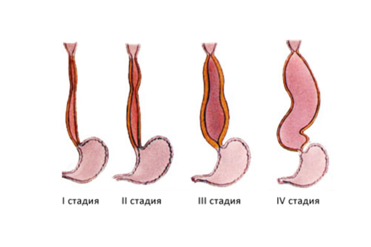 Стадии ахалазии