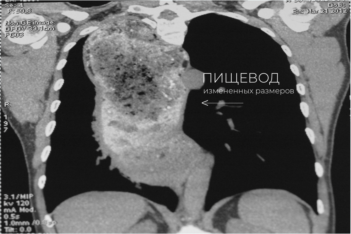 Мультиспиральная компьютерная томография (МСКТ) пациентки с ахалазией кардии IV стадии