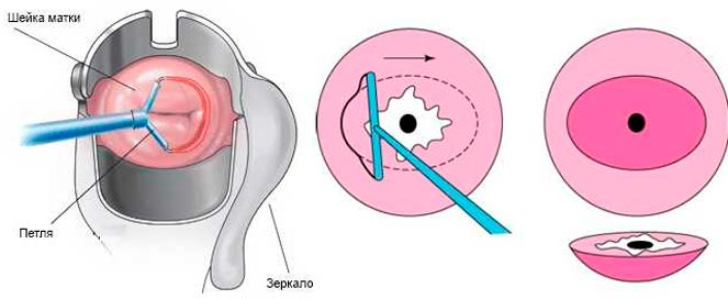 Гинекологическая электрохирургия на примере конизации матки