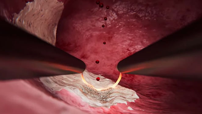 Коагуляция очага разрастания фиброидных тканей в ходе гистерорезектоскопии