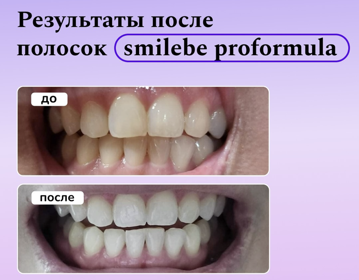 результаты после Smilebe