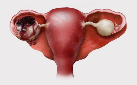 Апоплексия яичника- внезапное кровоизлияние в ткань яичника, сопровождающееся его разрывом и, зачастую, кровотечением в брюшную полость.