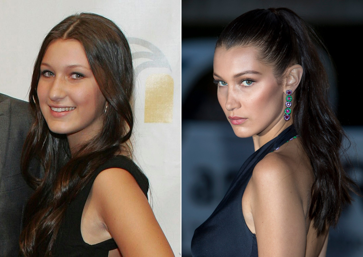 Белла Хадид до и после операции Ponytail Lift