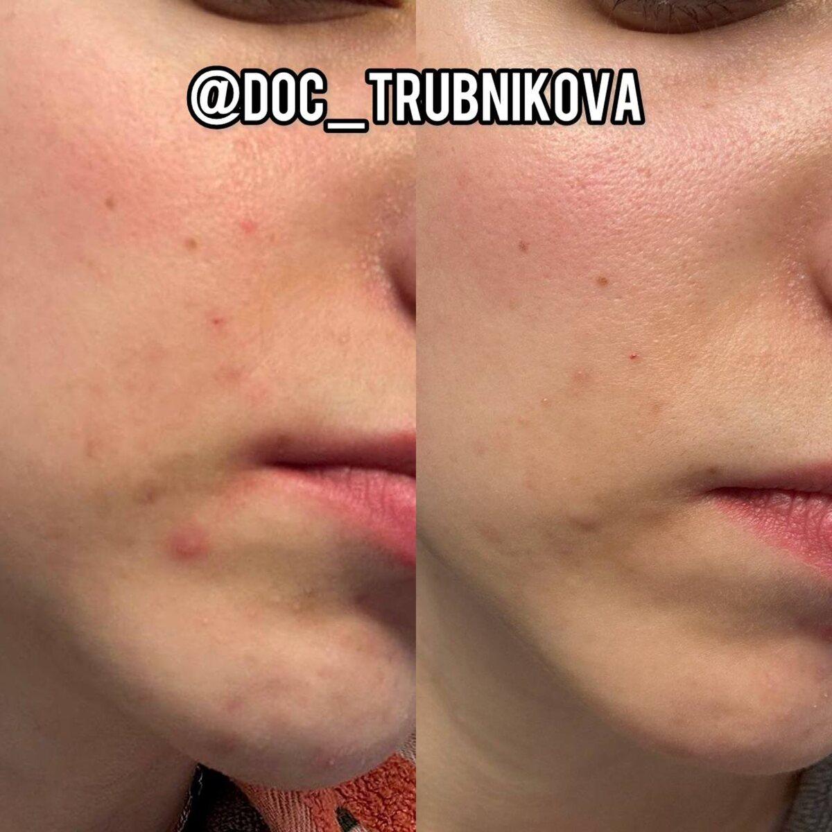 Курс плазмотерапии: 4 сеанса с интервалами в 7-14 дней и высыпаний стало меньше в разы 