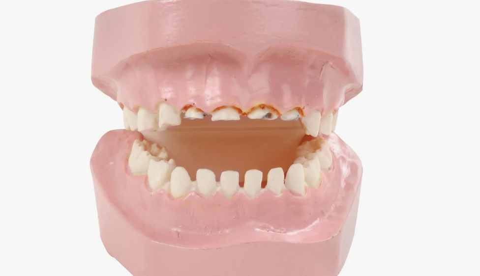 Зубы, пораженные бутылочным кариесом