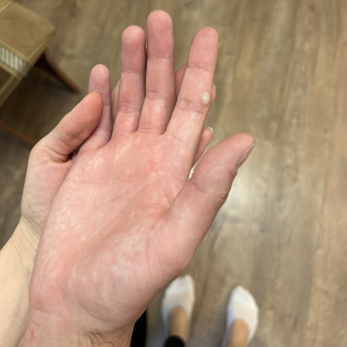 Тот самый ожог от гофры