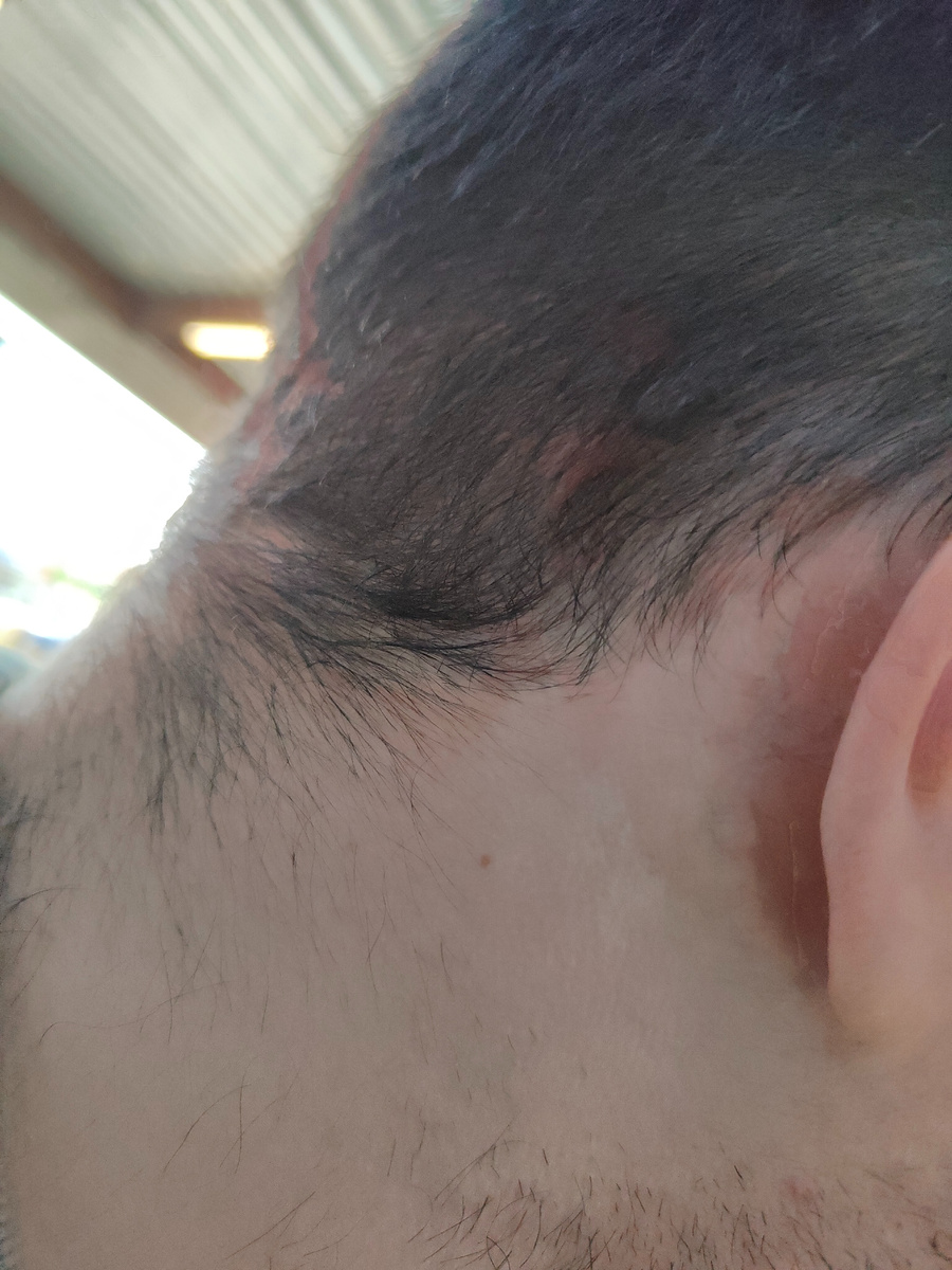 Пример раздражения на голове