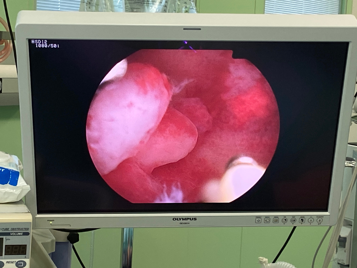 На фото кадр из операционной, на экране полип в полости матки