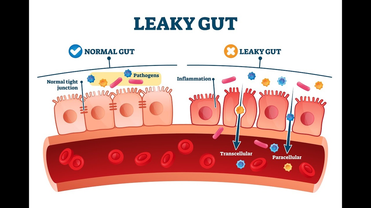 Синдром "дырявого кишечника"