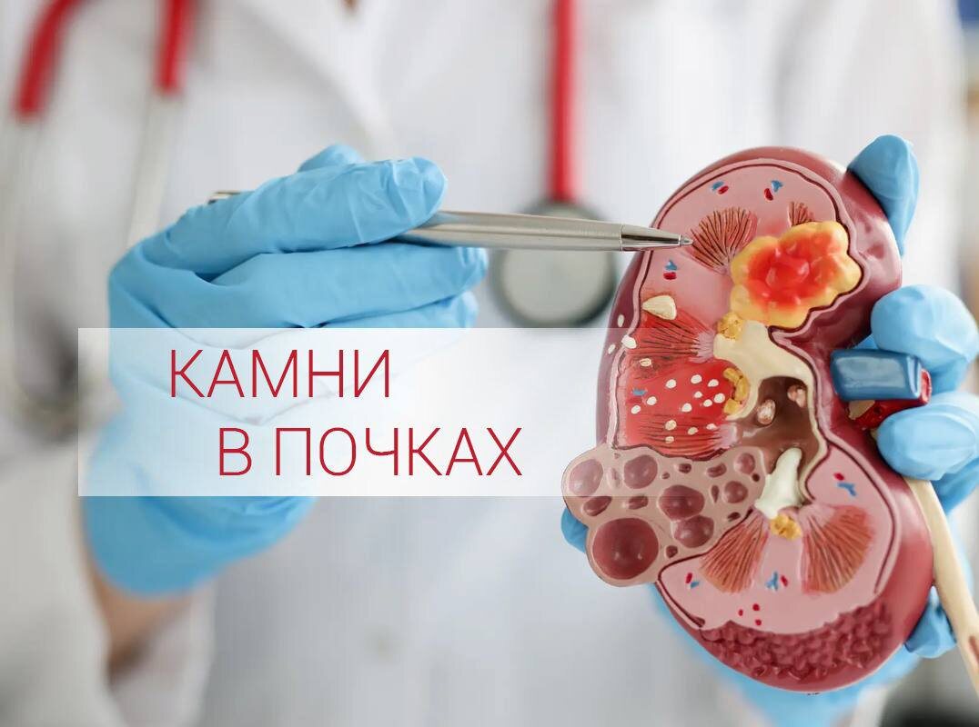 камни в почках