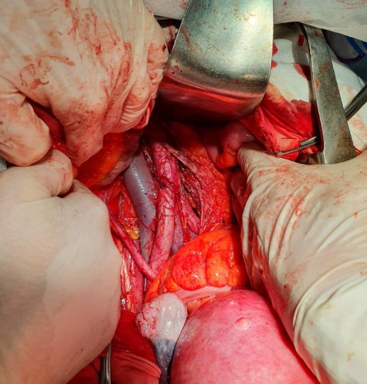 Аорта, нижняя полая вена, подвздошные сосуды и мочеточник