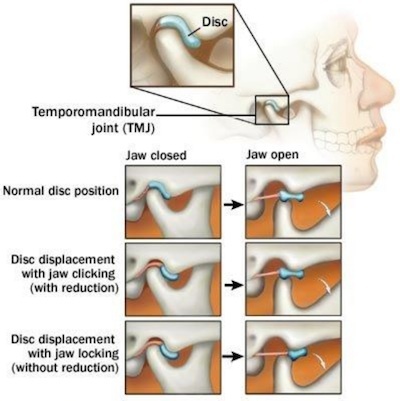 Механизм дисфункции височно-нижнечелюстного сустава 