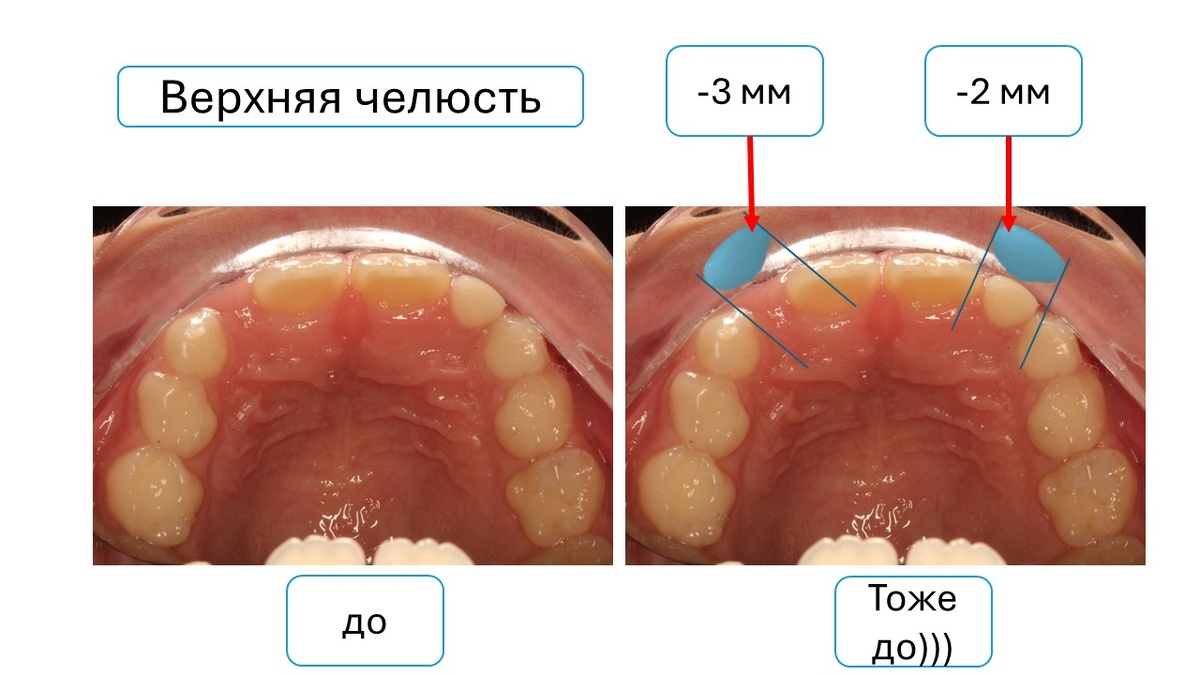 Оценка дефицита пространства на верхней челюсти