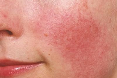 Купероз:зона щеки 