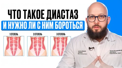 Что делать если у тебя диастаз | Нужно ли с ним бороться