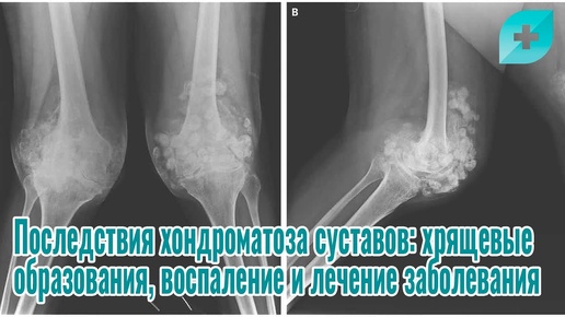 Последствия хондроматоза суставов: хрящевые образования, воспаление и лечение заболевания