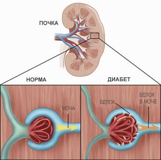 Механизм поражения почек при сахарном диабете