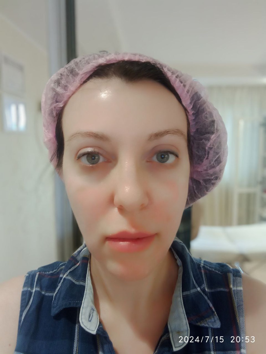 После процедуры у косметолога и с опухшим лицом.