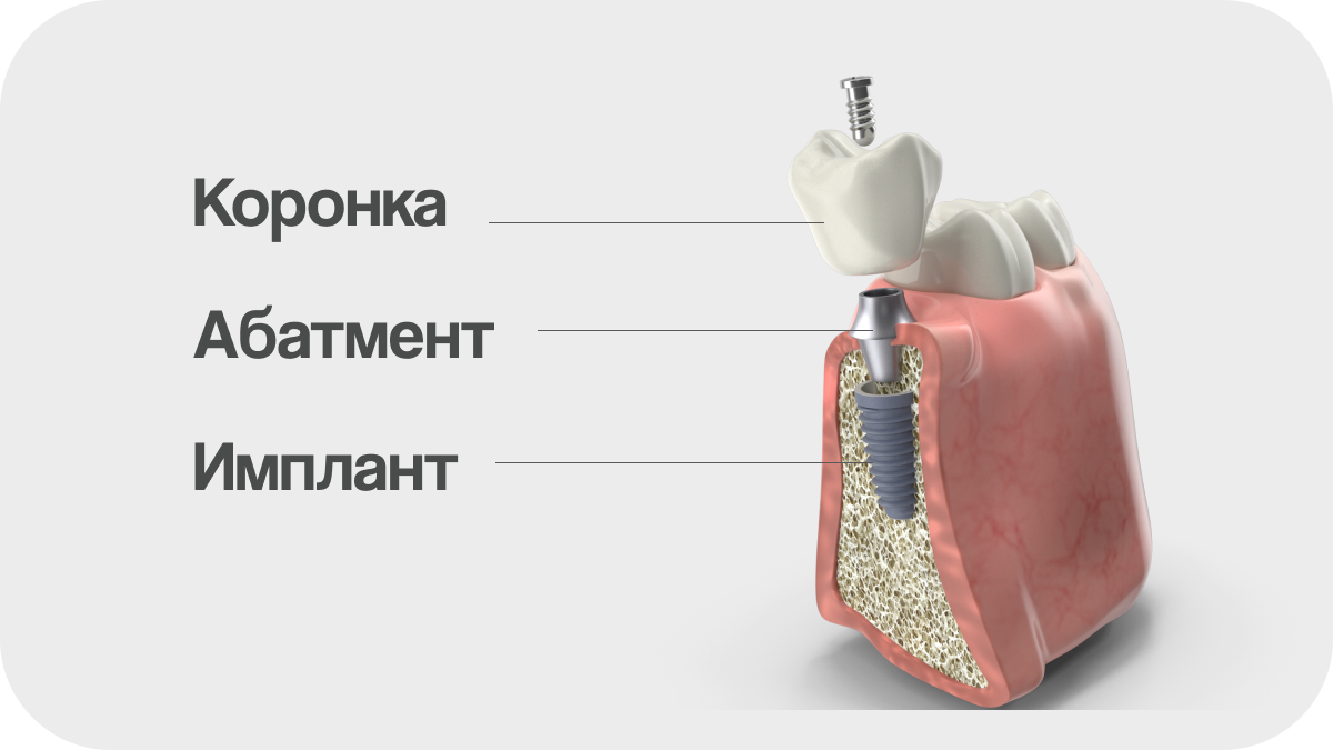 Как устроен имплант: коронка, абатмент, имплант