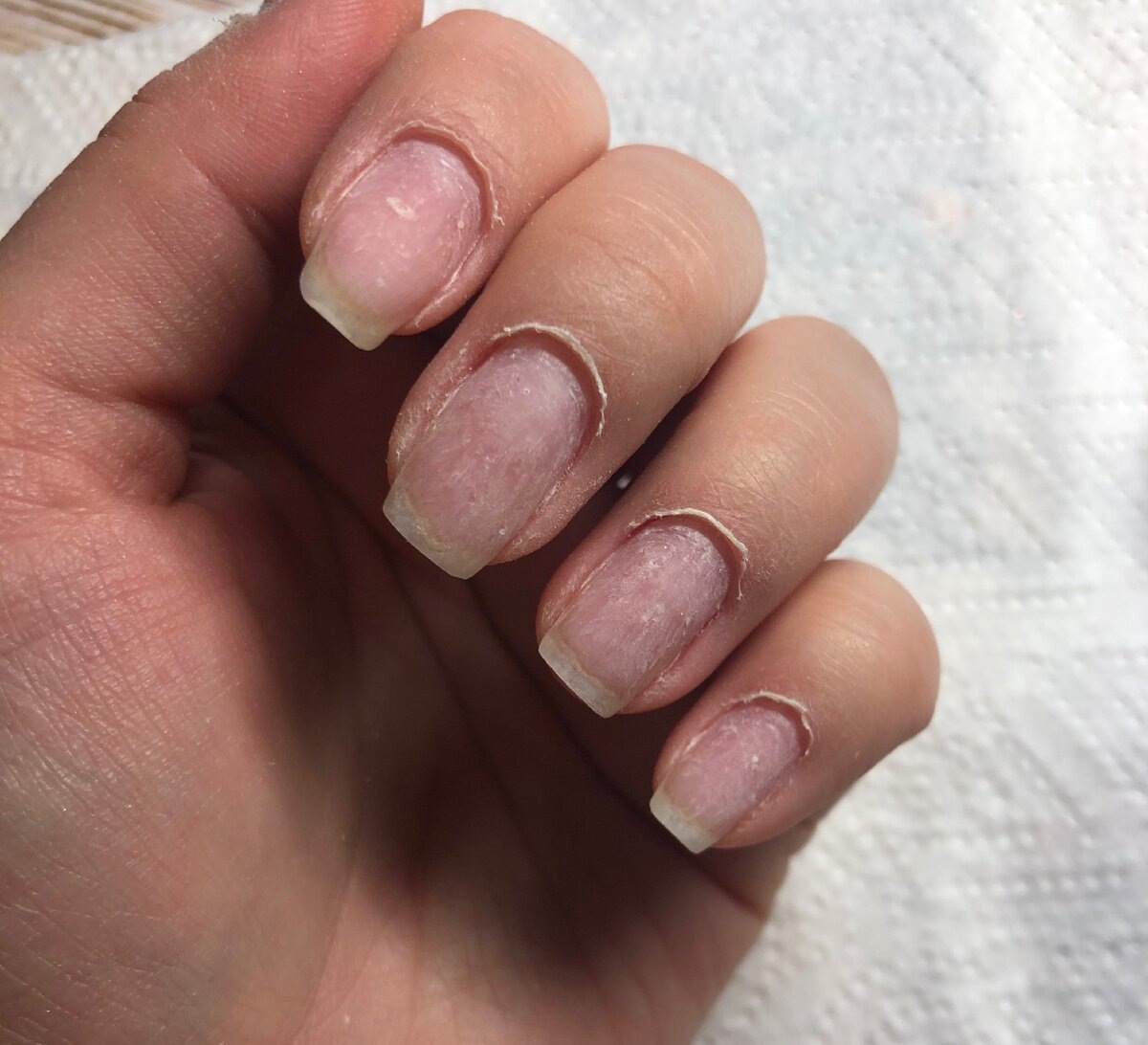 Приподнятая кутикула