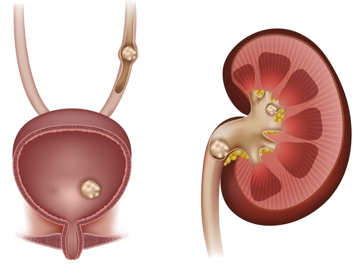 Симптомы камней в почках и способы их лечения — блог медицинского центра ОН Клиник