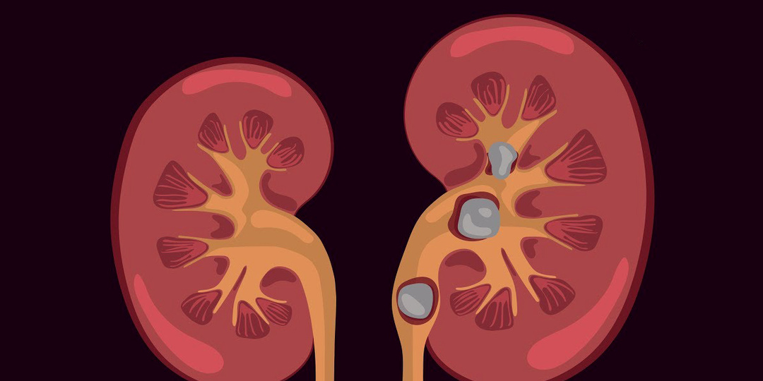 Камни в почках: симптомы, причины и последствия. Диагностика и лечение камней в почках — объясняет врач