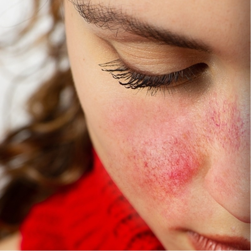 Если кожа на лице краснеет, становится чувствительной, на ней появляются сосудистые сеточки или воспалительные элементы, возможно, речь об обострении розацеа.