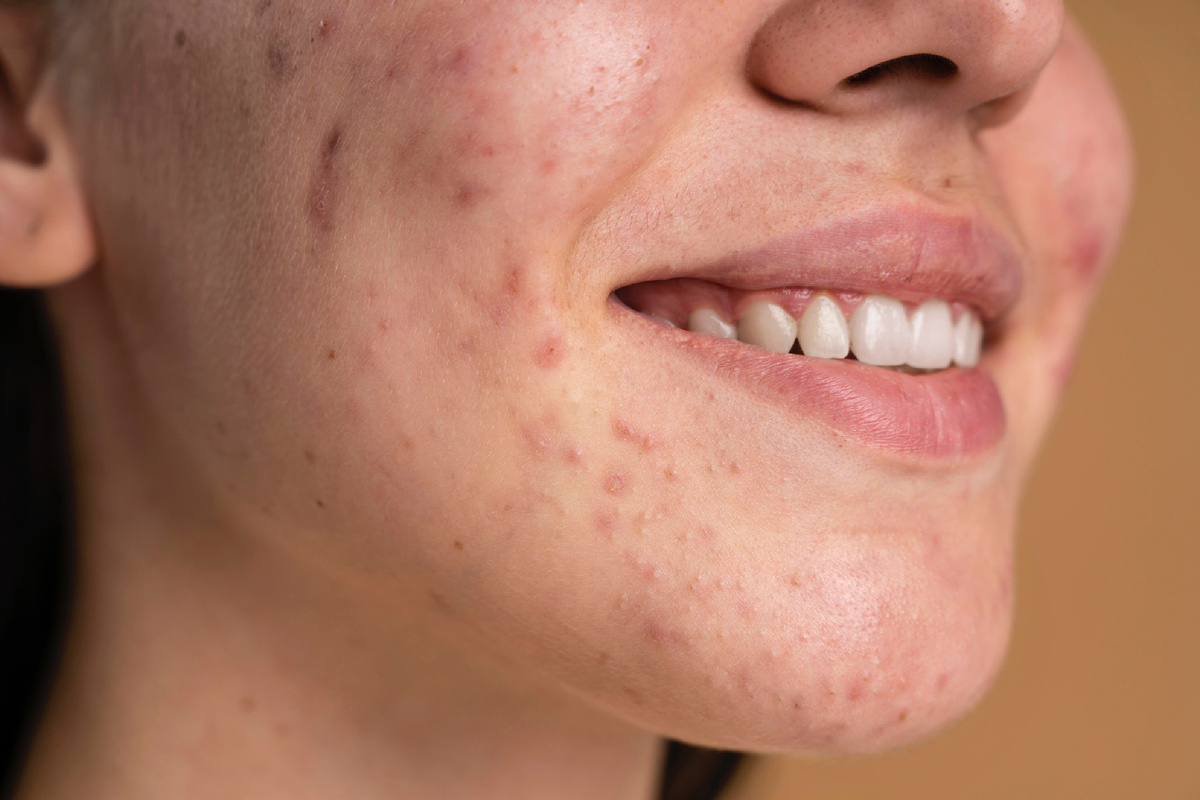 https://ru.freepik.com/free-photo/confident-young-woman-with-acne-close-up_14603069.htm#query=%D0%BF%D1%80%D1%8B%D1%89%D0%B8&position=3&from_view=keyword&track=ais_user&uuid=a75637b3-7b2e-4631-8017-f14ee1142aec