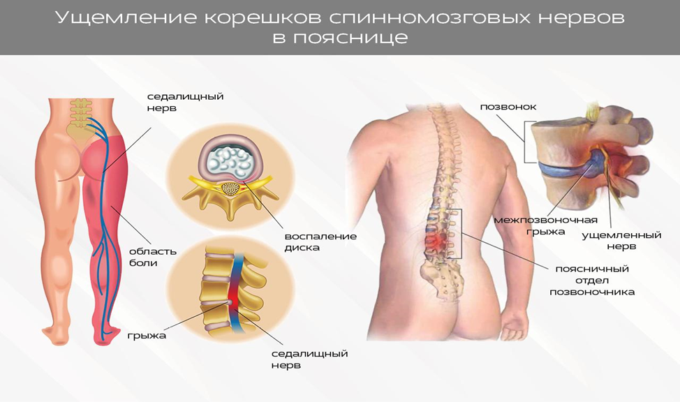 Иглоукалывание при защемлении нерва