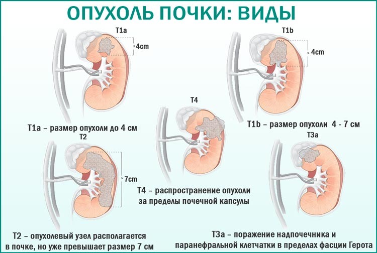 Рак почки? Как его распознать?