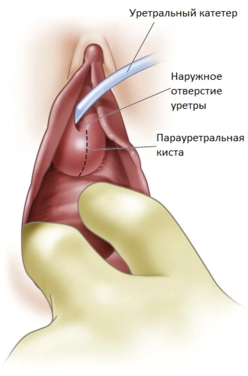 уретральный катетер для мужчин для чего | Дзен