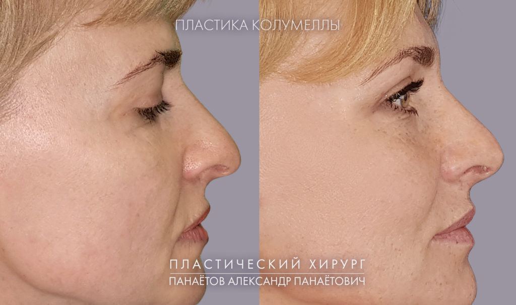 Пластика колумеллы, фото