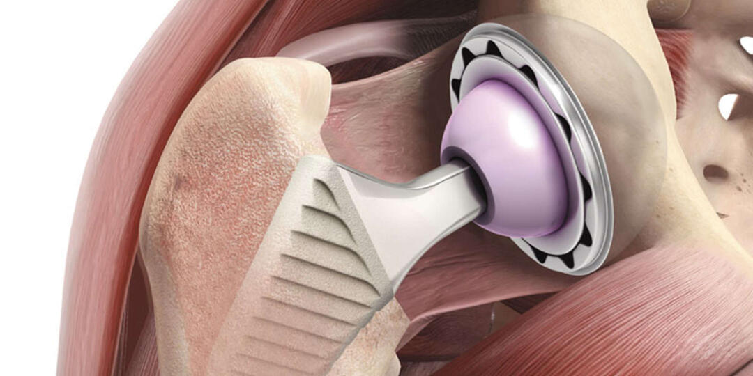 Простейшая памятка для пациентов после эндопротезирования тазобедренного сустава.