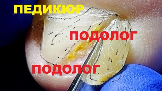 Осторожно, на одной стороне ногтя глубокая омертвевшая кожа и вросшие ногти. #Педикюр #Маникюр #Косметолог №1
