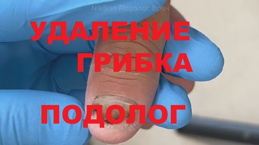 Осторожно, на одной стороне ногтя глубокая омертвевшая кожа и вросшие ногти. #Педикюр #Маникюр #Косметолог
