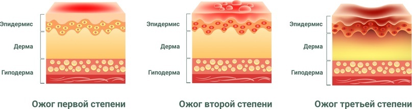 Можно ли использовать сметану или лёд? Или нам остаётся только сожалеть, что мы не взяли с собой солнцезащитный крем?-3